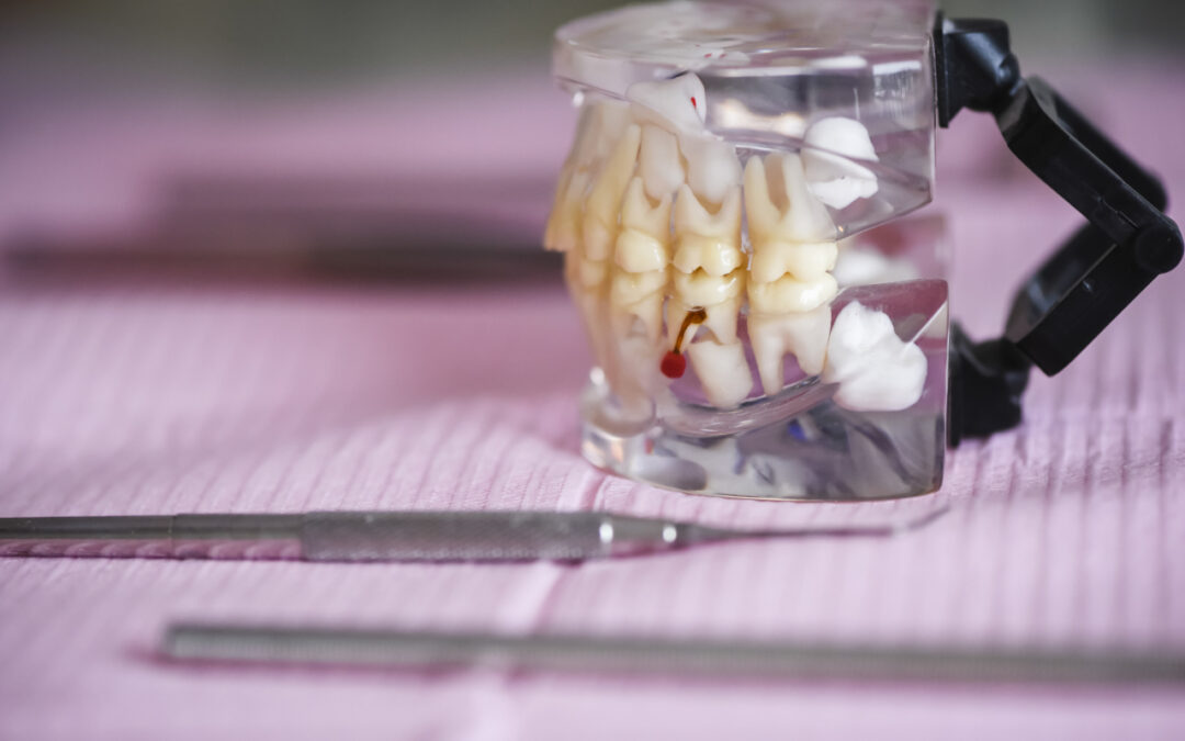 Dlaczego implanty dentystyczne poprawiają jakość życia w starszym wieku?